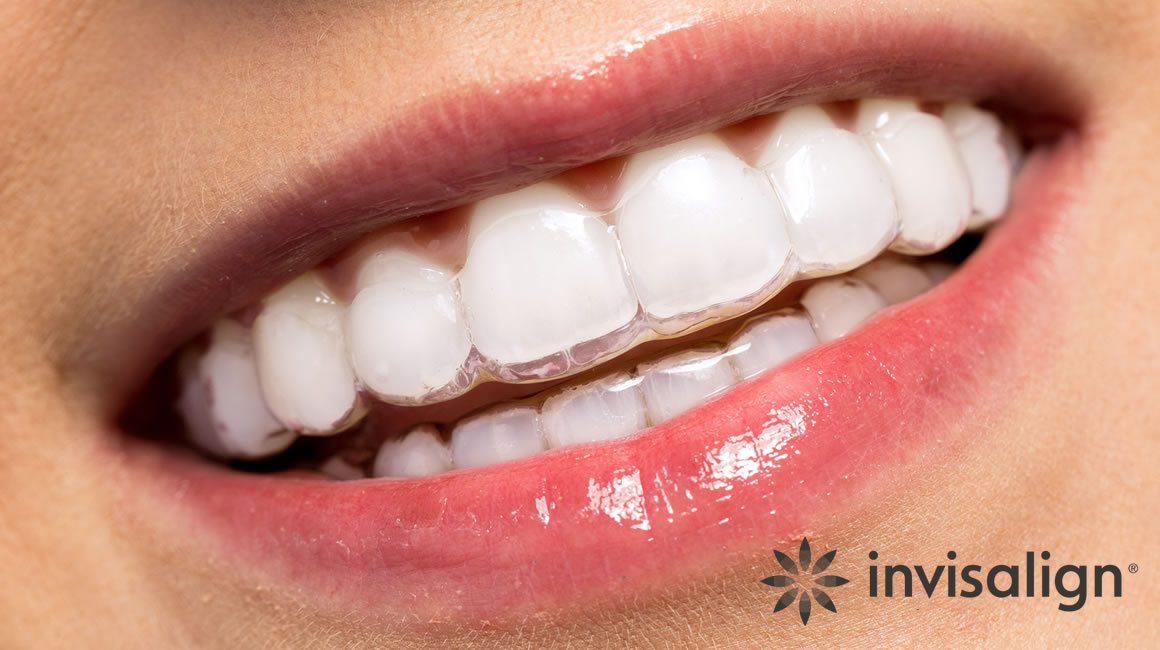img-invisalign-bis https://odontoiatrialatina.it/wp-content/uploads/2023/10/img-invisalign-bis.jpg