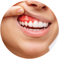 parodontite https://odontoiatrialatina.it/wp-content/uploads/2023/10/parodontite.png